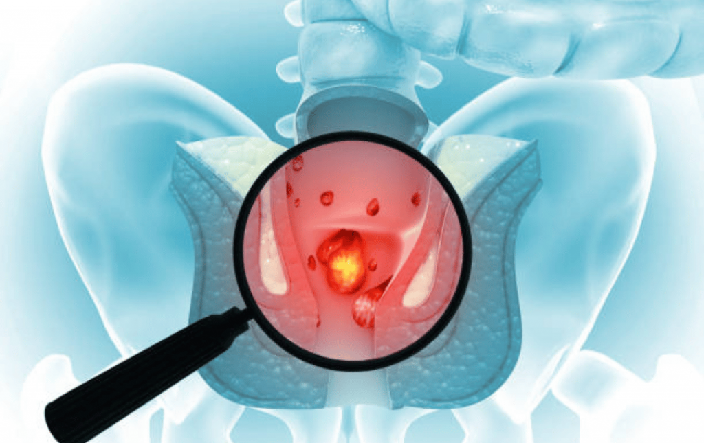 Hemorrhoid Grading System: Stages & Degree Classification